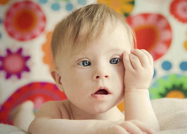عکس گوش نوزاد سندروم داون