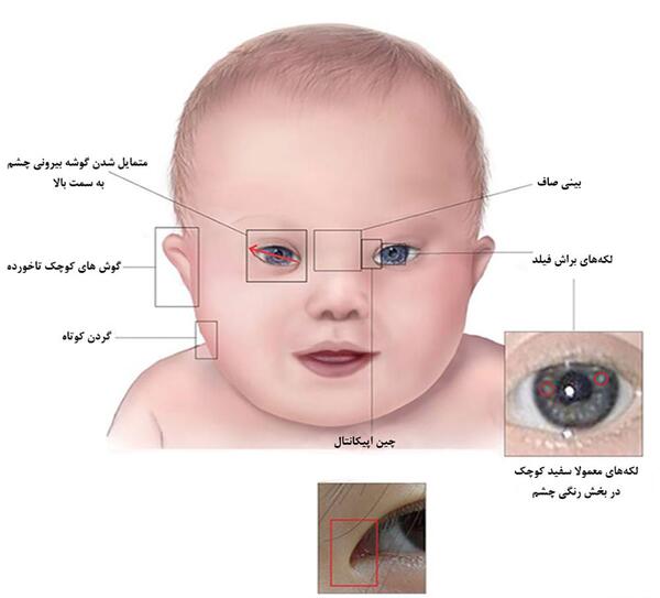 عکس گوش نوزاد سندروم داون