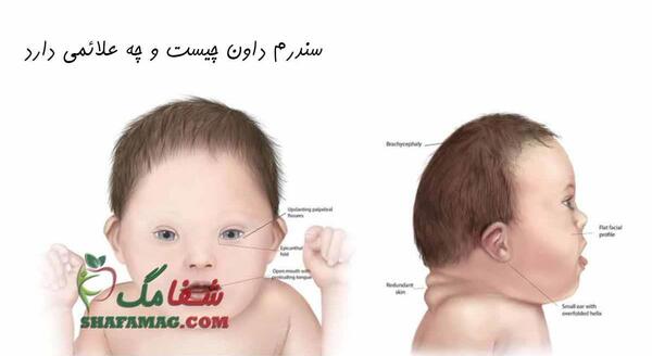 عکس گوش نوزاد سندروم داون