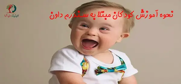 عکس زبان نوزاد سندروم داون