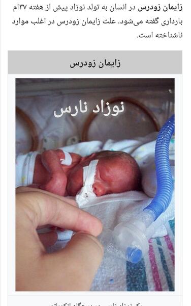 عکس نوزاد نارس 30 هفته