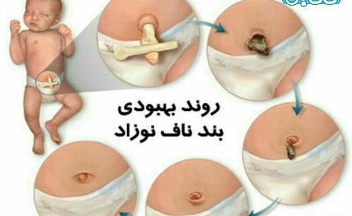 عکس ناف طبیعی نوزاد