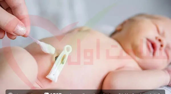 عکس ناف طبیعی نوزاد