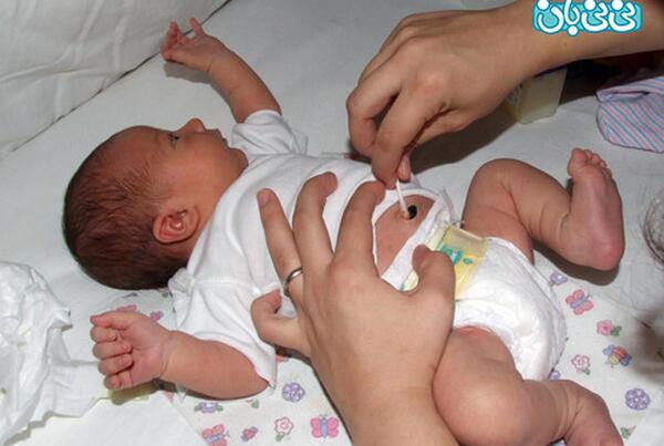 عکس ناف طبیعی نوزاد