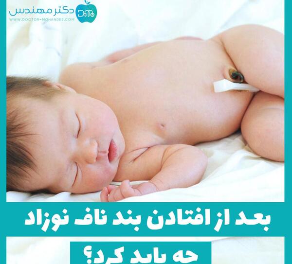 عکس ناف طبیعی نوزاد