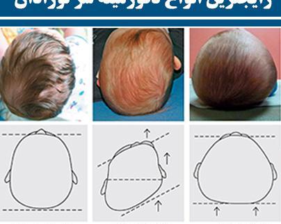 عکس شکل طبیعی سر نوزاد