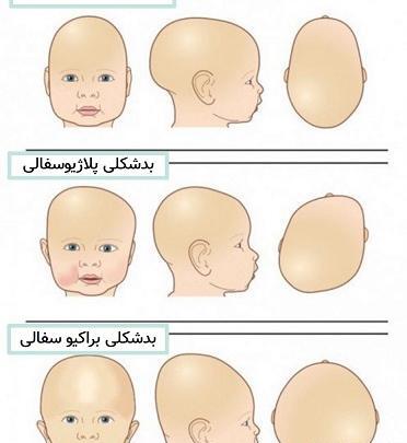 عکس شکل طبیعی سر نوزاد