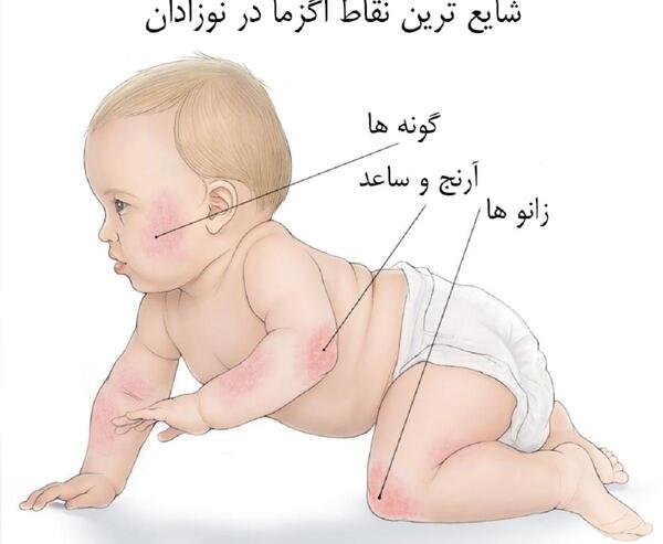 عکس اگزما صورت نوزاد