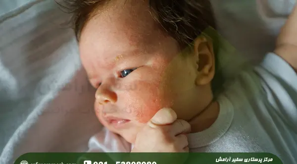عکس اگزما صورت نوزاد
