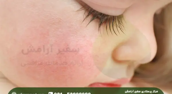 عکس اگزما صورت نوزاد