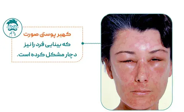 عکس کهیر صورت نوزاد
