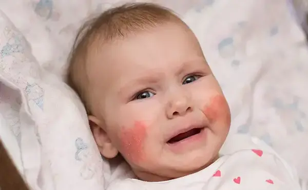 عکس کهیر صورت نوزاد