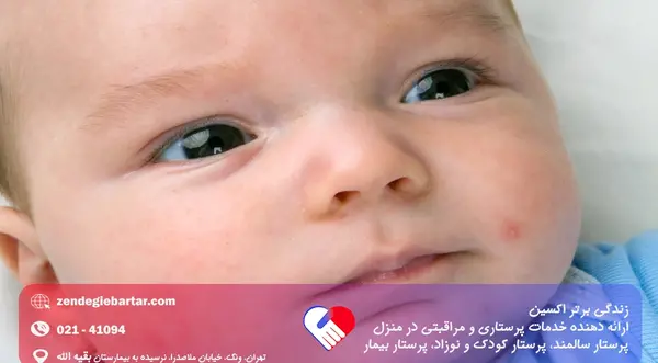 عکس گرمی صورت نوزاد
