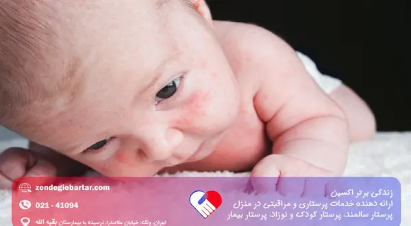 عکس گرمی صورت نوزاد