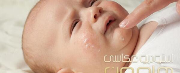 عکس گرمی صورت نوزاد