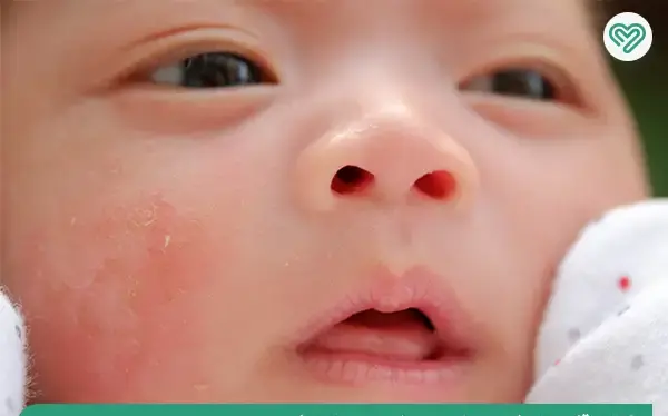 عکس گرمی صورت نوزاد