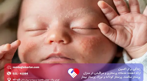 عکس گرمی صورت نوزاد