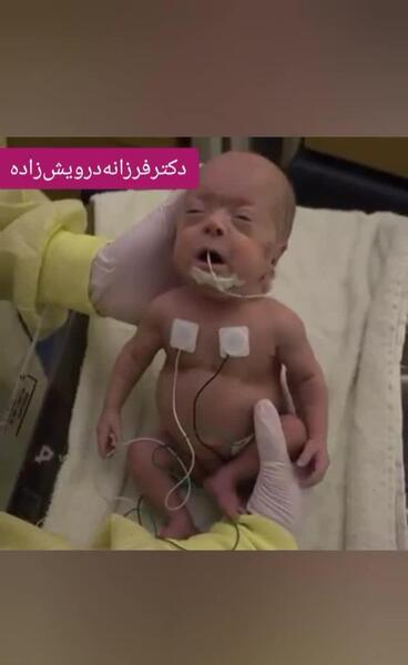 عکس نوزاد نارس شش ماهه