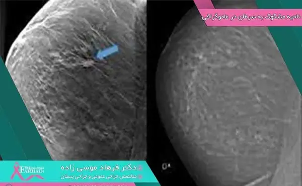عکس ماموگرافی چیست