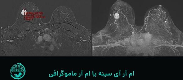 عکس ماموگرافی سرطان