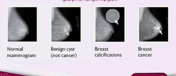 عکس ماموگرافی سرطان