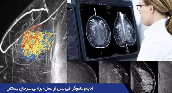عکس ماموگرافی ناسالم
