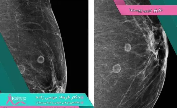 عکس ماموگرافی ناسالم