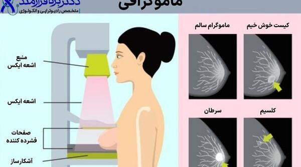 عکس ماموگرافی کیست