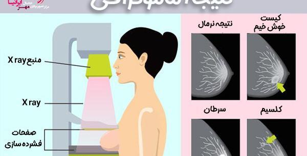 عکس ماموگرافی نی نی سایت