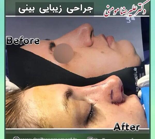 عکس مومو قبل از عمل نی نی سایت