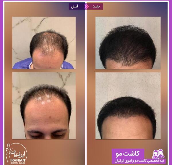 عکس مومو قبل از عمل و بعد از عمل