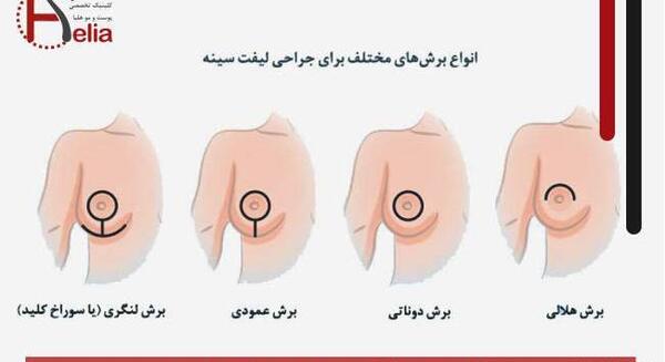 عکس مومو بعد از عمل زیبایی