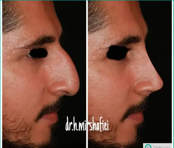 عکس بینی نیمه فانتزی مردانه
