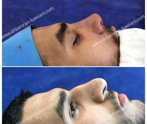 عکس بینی نیمه فانتزی مردانه