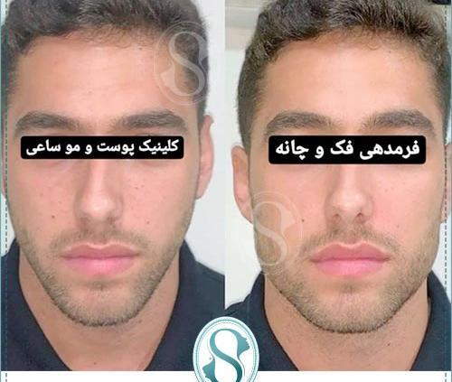 عکس زاویه سازی صورت مردانه