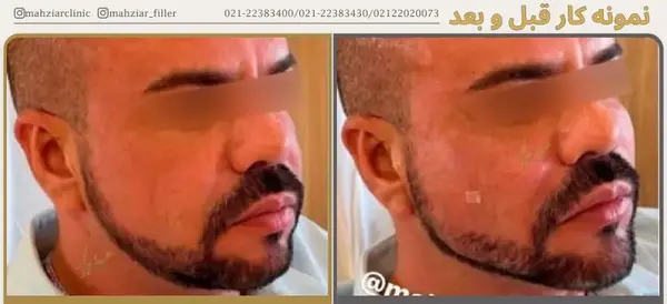 عکس زاویه سازی صورت مردانه