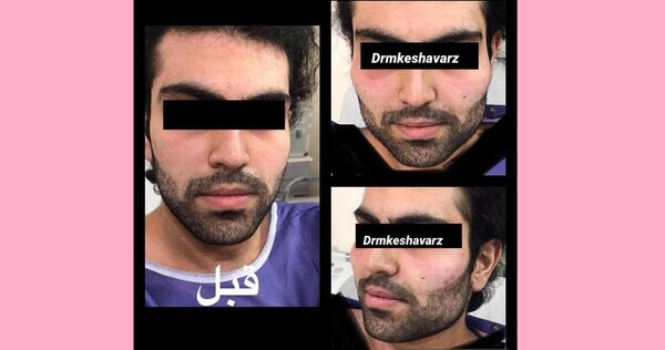 عکس زاویه سازی صورت مردانه