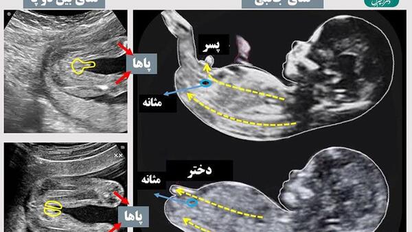 عکس سونوگرافی جنین یک ماه