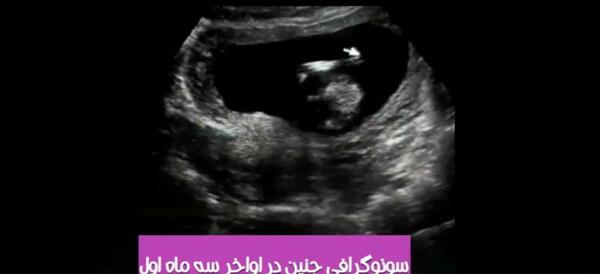 عکس سونوگرافی جنین یک ماه