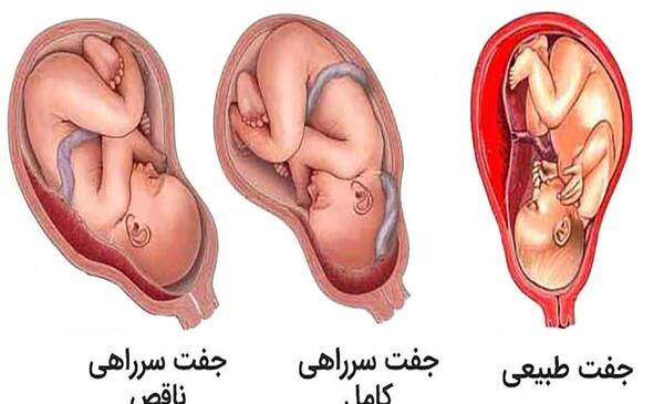 عکس جنین سقط شده زیر یک ماه