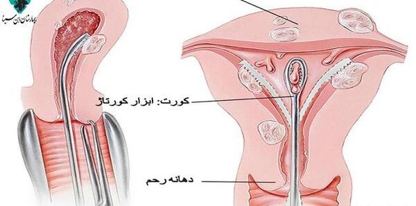عکس جنین سقط شده زیر یک ماه