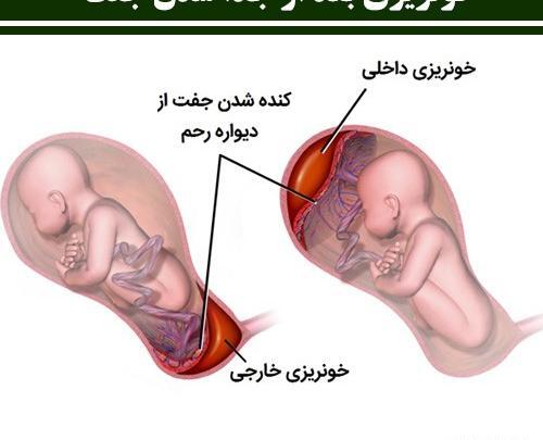 عکس جنین سقط شده زیر یک ماه