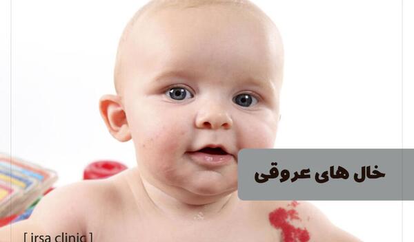 عکس ماه گرفتگی روی صورت نوزاد