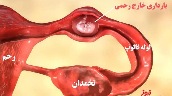 عکس رنگ لکه بینی در بارداری