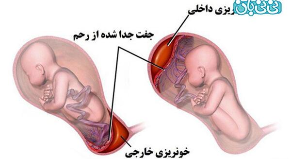 عکس لکه بینی قهوه ای در بارداری