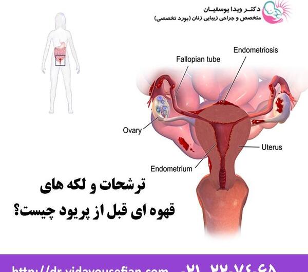 عکس تصویر لکه بینی در بارداری