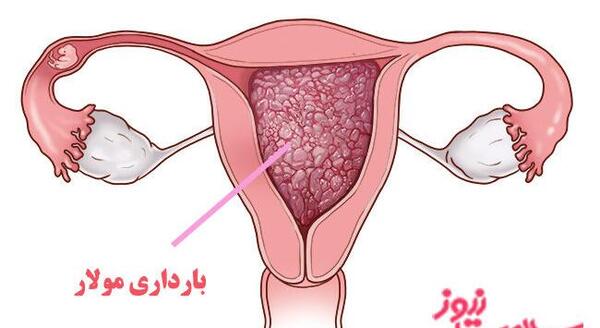 عکس لکه بینی صورتی در بارداری