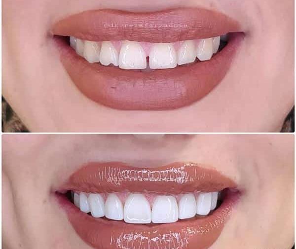 عکس کامپوزیت دندان طرح لبخند