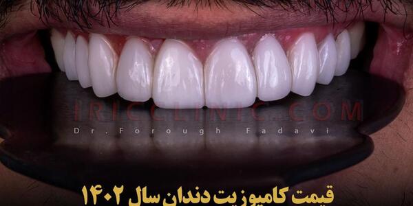 عکس کامپوزیت دندان طرح لبخند