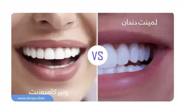 عکس کامپوزیت دندان طرح لبخند